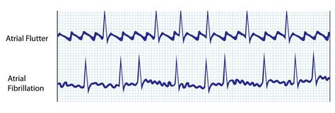 Atrial Fibrillation Vs Atrial Flutter