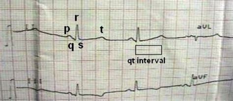 ECG recording showing prolonged QTc interval. | Download Scientific Diagram