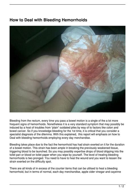 How to Deal with Bleeding Hemorrhoids by felix Batista - Issuu