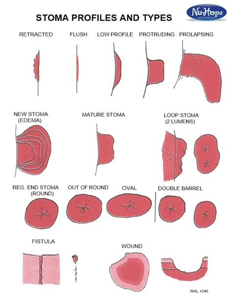 Stoma Types