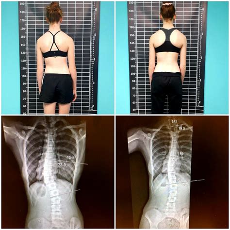 BEFORE & AFTER - Curvy Spine