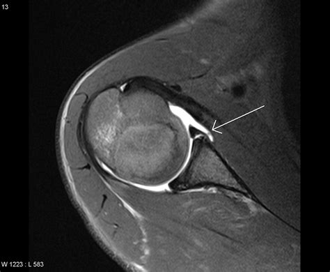 Mri Shoulder Labrum Tear