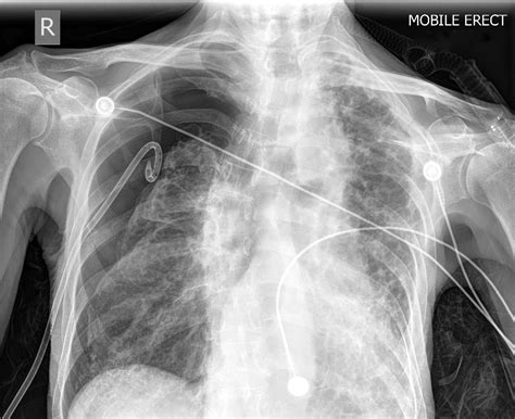 Chest X Ray Showing Right Pneumothorax With An Intercostal Drain In ...