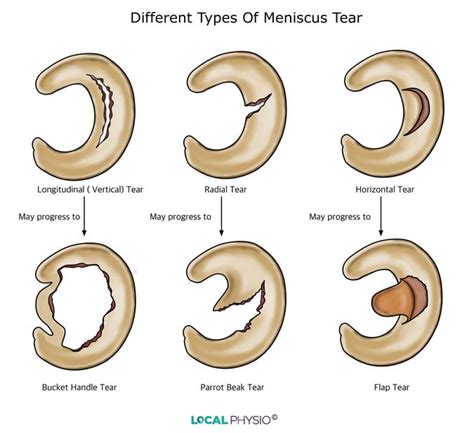 Torn Meniscus | ELIM RHEUMATIC CENTRE