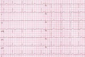 Normal Tracing - ECGpedia