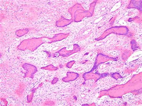 Histology Of Osteosarcoma