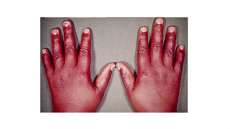 Myxedema: What it Is, Characteristics and Associated Symptoms | 2024