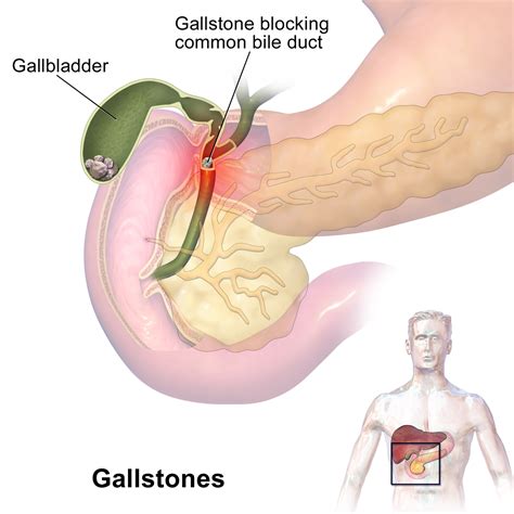 Gallstone - Wikipedia