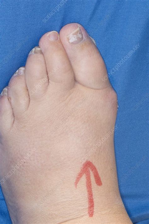 Bunion surgery - Stock Image - M551/0523 - Science Photo Library