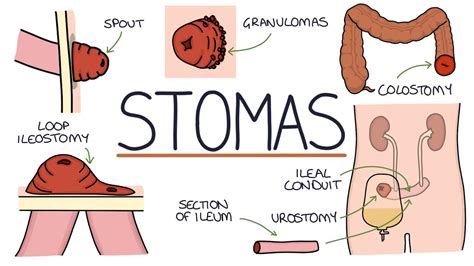 Understanding Stomas (Colostomy, Ileostomy, Urostomy and Gastrostomy ...