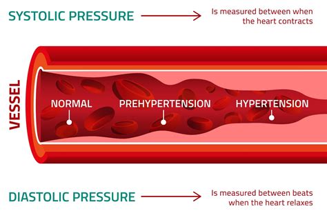 What Causes High Blood Pressure?