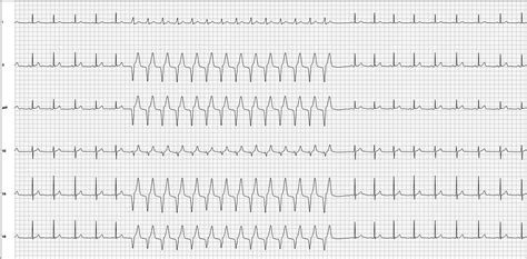 ECG Basics: Accelerated Idioventricular Rhythm | ECG Guru - Instructor ...