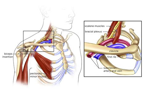 Thoracic Outlet Syndrome - Goodman Campbell