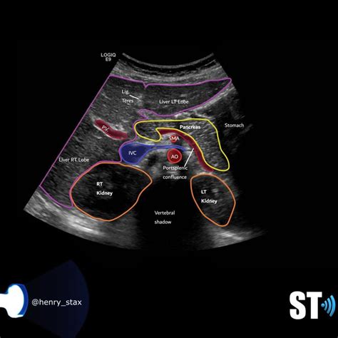 Liver Anatomy and Protocol basics – Sonographic Tendencies | Liver ...