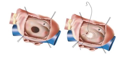 Best ASD Closure Doctors & Hospitals in India