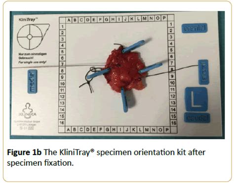 Specimen Orientation in Breast Conserving Surgery: An Argument fo