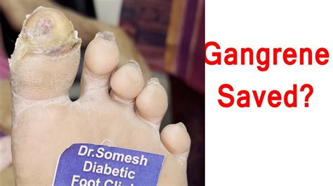 #callus Toe Gangrene Before After #diabeticfoot #toeinfection of big ...