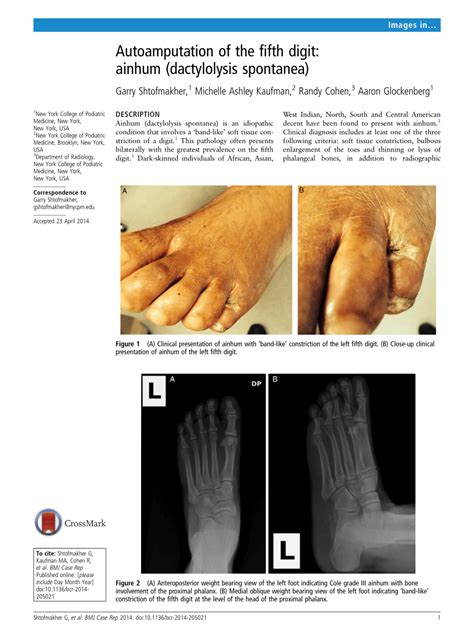 (PDF) Autoamputation of the fifth digit: Ainhum (dactylolysis spontanea)