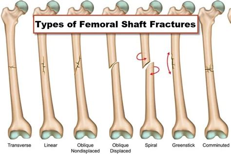 Closed Femur Fracture