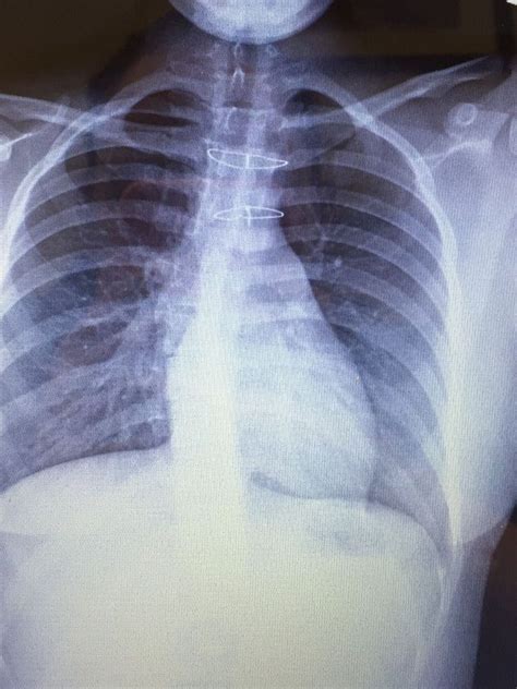 2 sternal wires placed after chest was cracked to fix aorta - MEDizzy