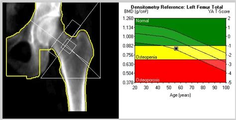 DXA Tests: What you must know