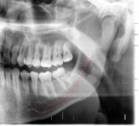 Radiographic image of the mandibular canal type 1 (red traces) in ...