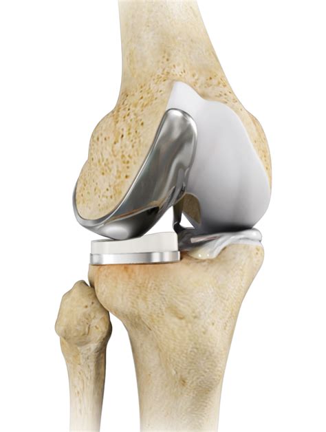 Unicondylar Knee Replacement | Partial Knee Replacement | Atlanta