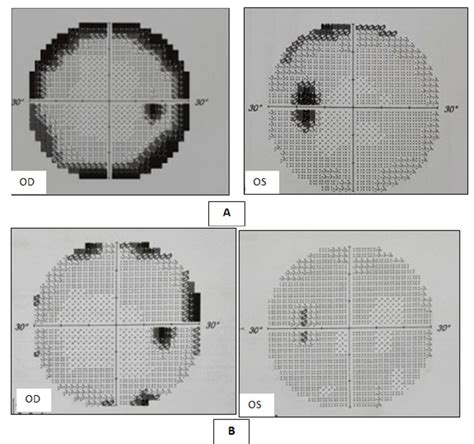 (A) Humphrey Visual Field test on 1/2/2021 showed an enlarged blind ...