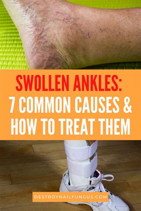 How To Treat Swollen Ankles: 7 Best Treatment Options