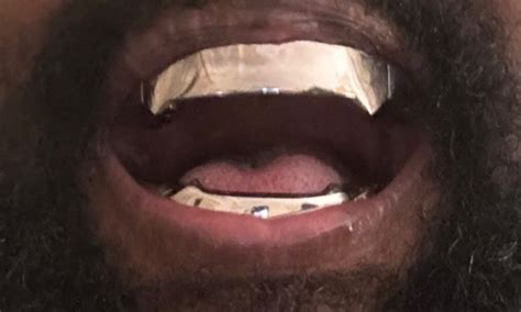 Kanye West shows off his Jaws-inspired dental work - Dental Times