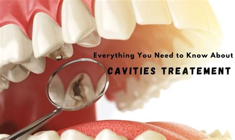 Everything You Need to Know About Cavities Treatment – Richardson's ...