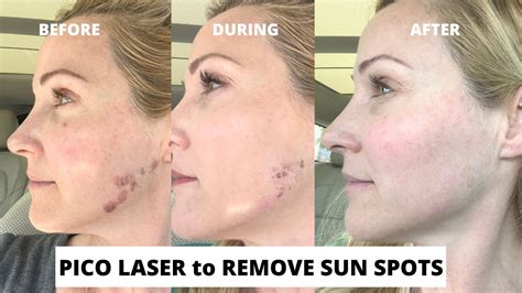 Pico Laser Treatment to Remove Sun Spots Before and After | With Dr ...