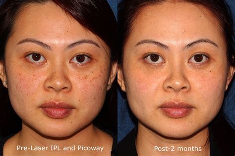 Laser IPL and Picoway before and after for brown spots by Dr. Wu. Ipl ...