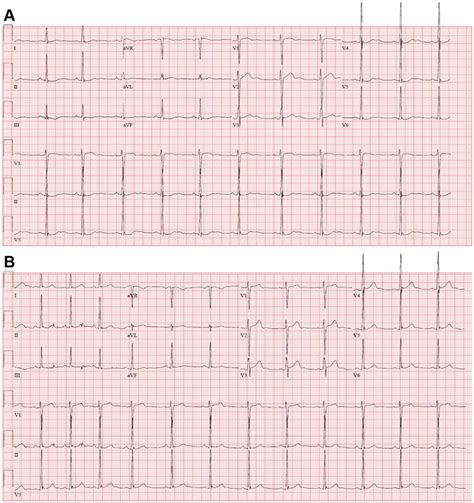 A: Electrocardiogram (ECG) obtained during hypokalemia showing normal ...