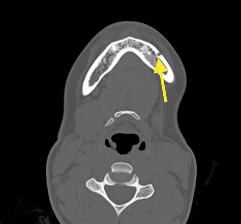 Mandibular canal | Image | Radiopaedia.org