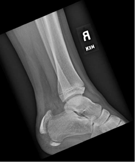 Open Reduction and Internal Fixation of a Pediatric Apophyseal ...