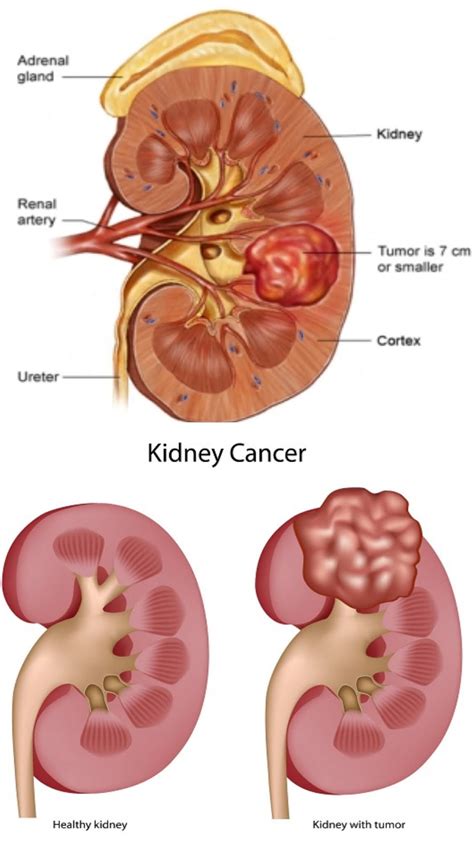 Kidney Tumor - Symptoms and Cure