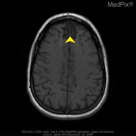 Traumatic Brain Injury Mri