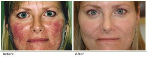 Photodynamic Therapy for Acne - Berman Skin Institute