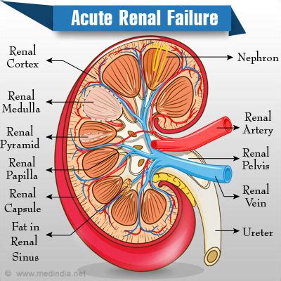 Acute Renal (Kidney) Failure- Causes, Symptoms, Diagnosis, Treatment ...