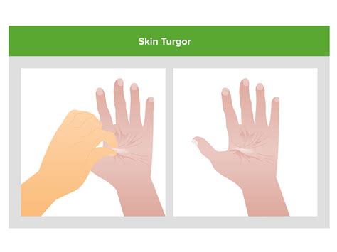 Volume Depletion and Dehydration | Concise Medical Knowledge