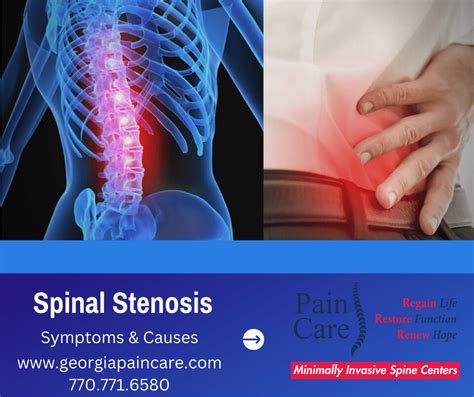 Spinal Stenosis: Symptoms & Causes (part 1): Pain Care, LLC ...