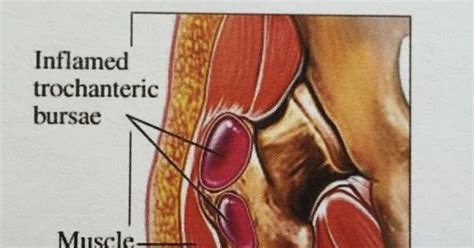 The Injury Zone: Hip Bursitis