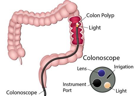 Sigmoidoscopy | Johns Hopkins Medicine