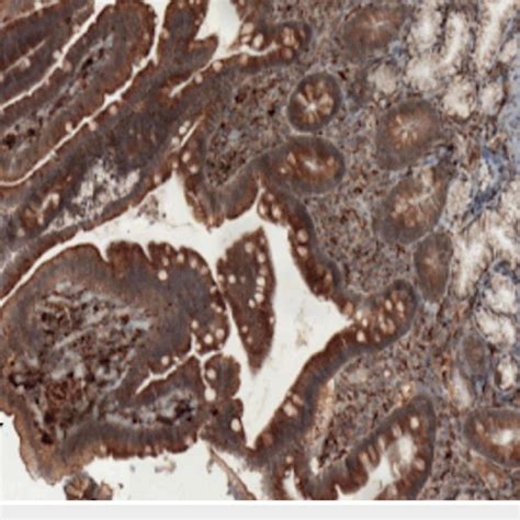 Electron microscopy of foamy macrophages of duodenal xanthoma ...