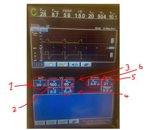 Mechanical Ventilation- Ventilation Screen, what do some of those ...