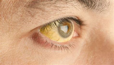 Yellow eyes: Causes in newborns, children, and adults