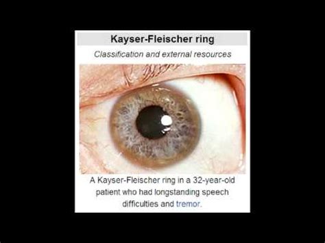 Kayser-Fleischer Rings (Copper accumulation from Wilson's Disease ...