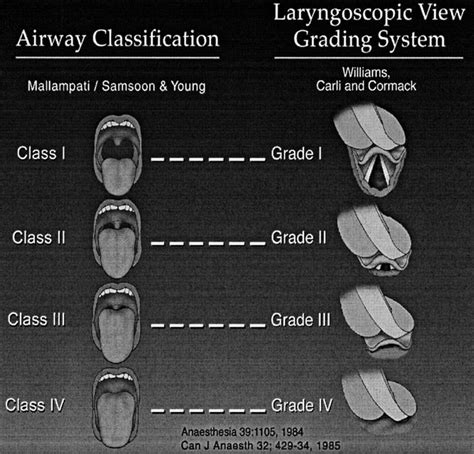 Mallampati score | Copd treatment, Nursing notes, Nurse anesthesia