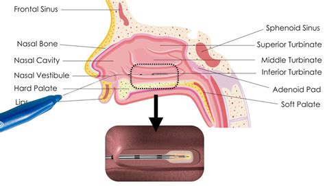 turbinate-reduction - Fort Worth ENT & Sinus